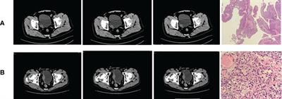 Machine learning models combining computed tomography semantic features and selected clinical variables for accurate prediction of the pathological grade of bladder cancer